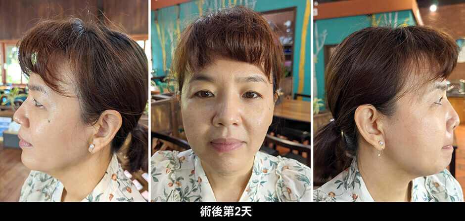 下巴 雷射減脂 抽脂