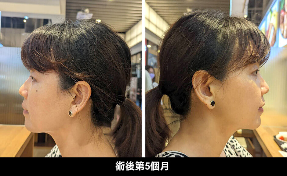 下巴抽脂 下巴 輪廓線