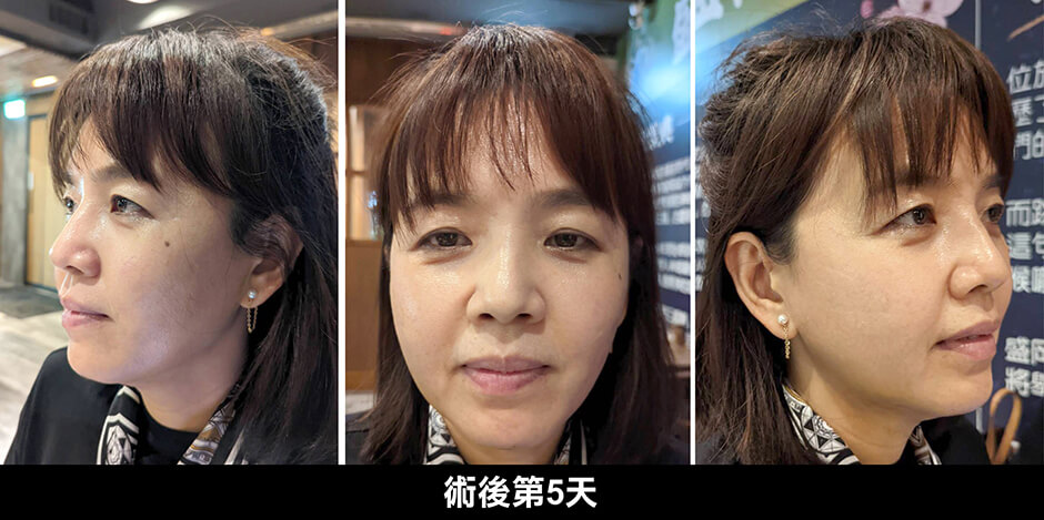 下巴抽脂 下巴 抽脂