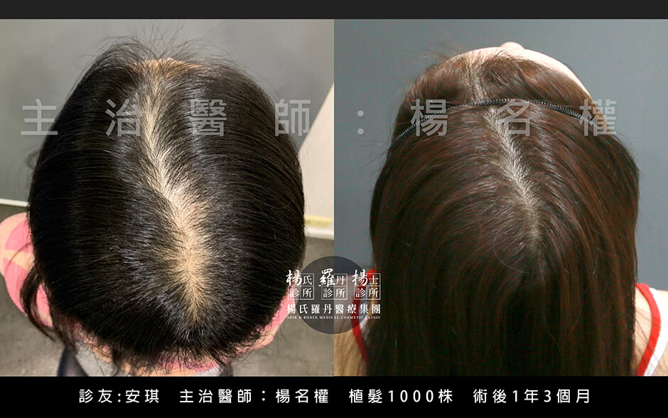 植髮 植髮手術 落髮 六合一三階段雄性禿治療
