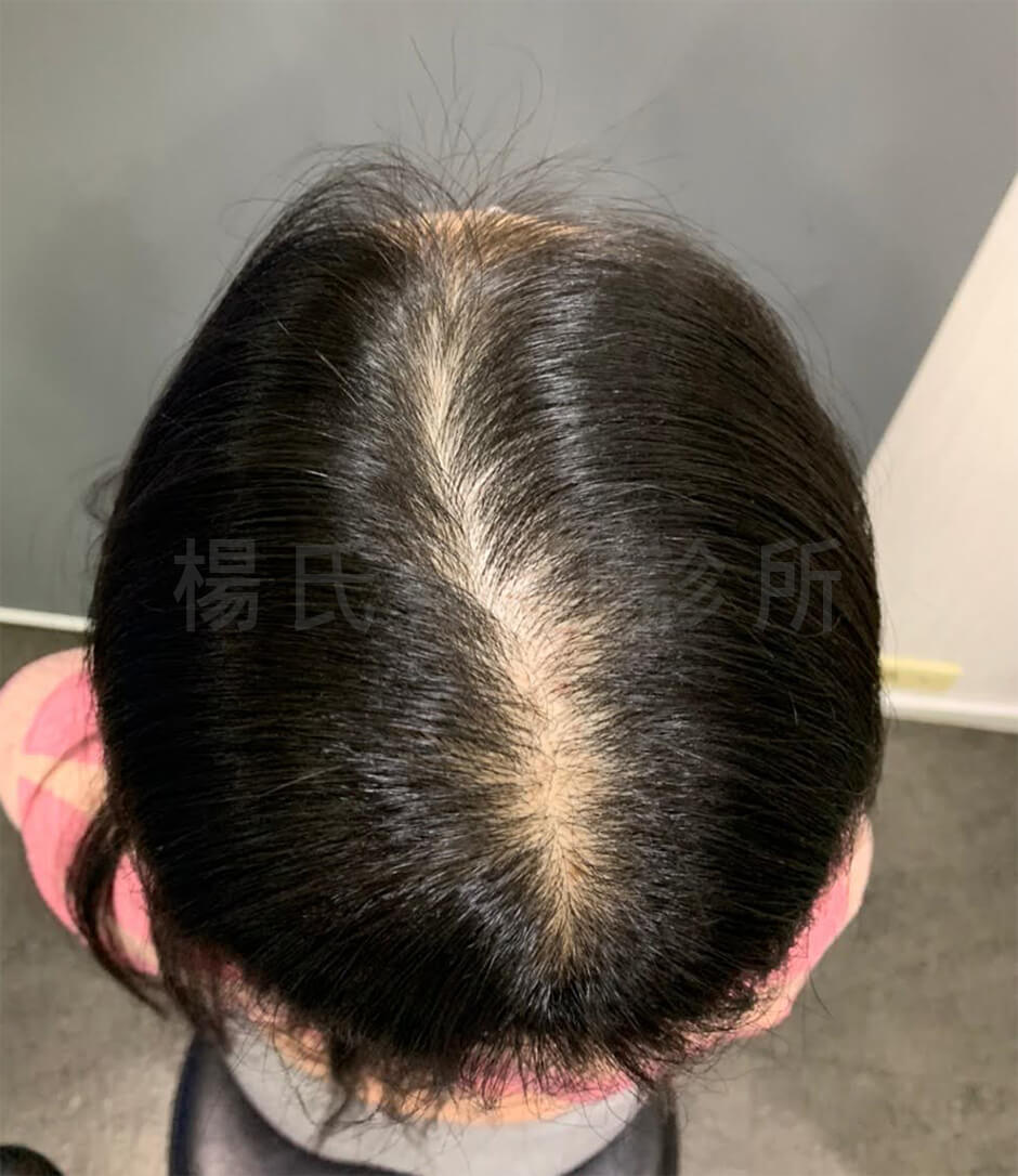 植髮 美型植髮 髮際線 生髮613
