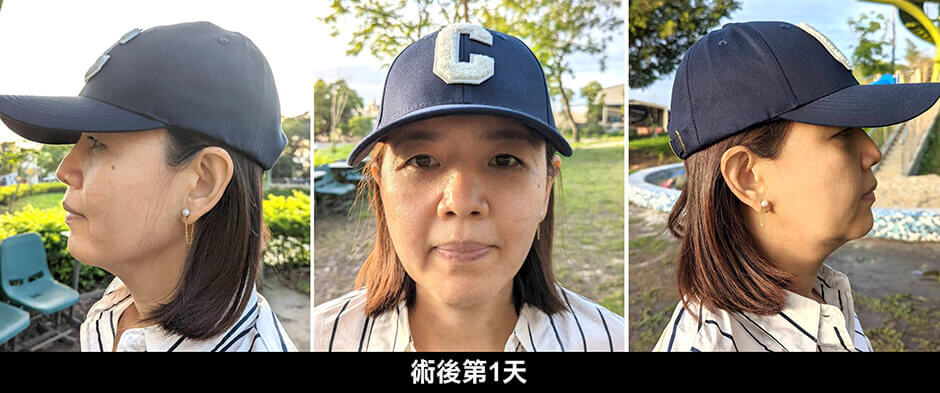 下巴抽脂 抽脂 雷射減脂