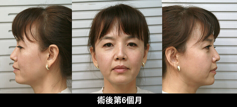 下巴 雷射減脂 抽脂