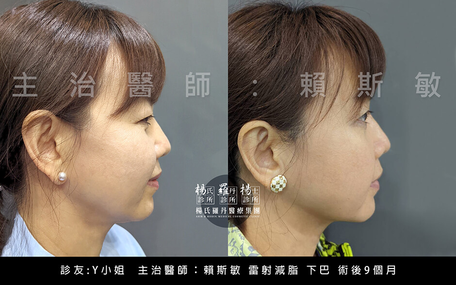 雷射減脂 下巴 下巴抽脂 