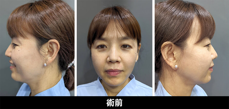 抽脂 下巴 雷射減脂