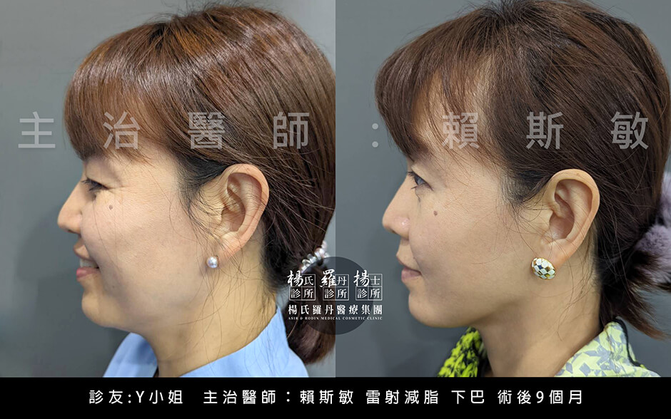 抽脂肪 下巴抽脂 下巴