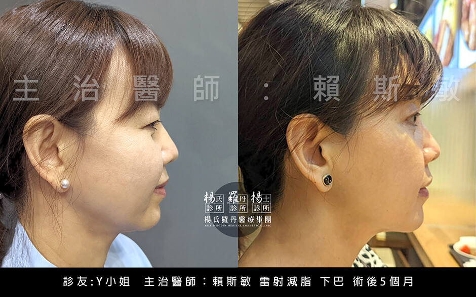 雷射減脂 抽脂 下巴