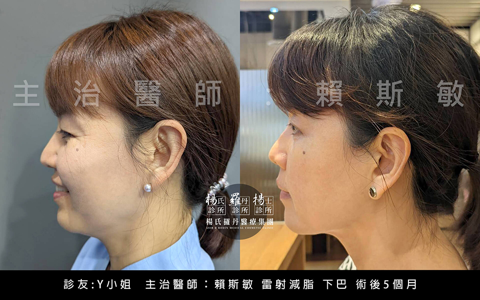 雷射減脂 下巴抽脂 下巴