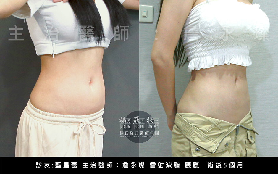 星蕾 雷射減脂 贅肉 腰腹抽脂