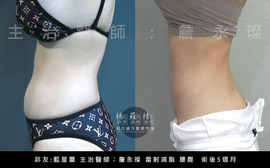 纖女腰 星蕾 腰腹抽脂 雷射減脂 瘦小腹