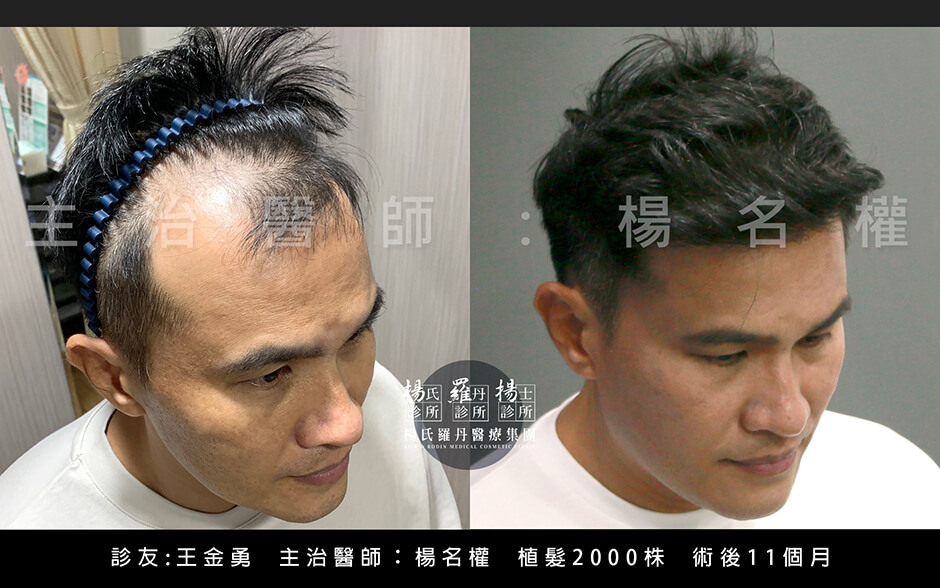 植髮 王金勇 植髮手術 六合一三階段雄性禿治療