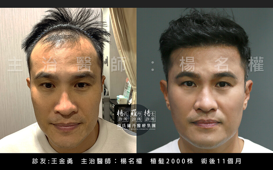 落髮 植髮 植髮手術 生髮613