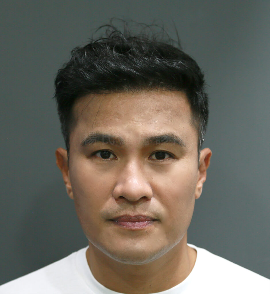 王金勇 植髮 六合一三階段雄性禿治療 植髮手術