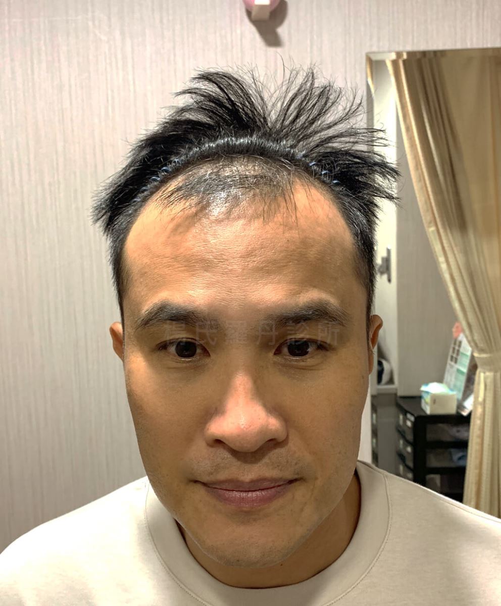 植髮 王金勇 雄性禿 生髮613