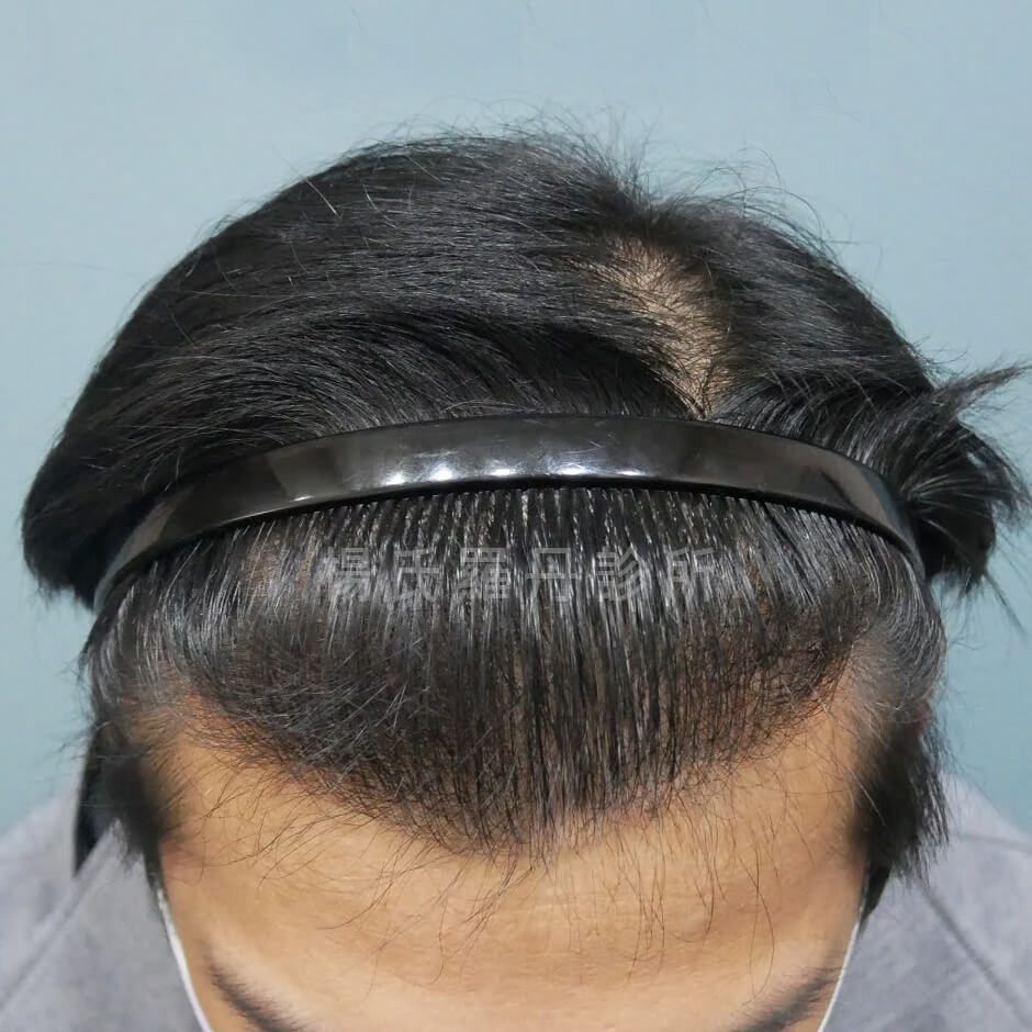 禿頭 植髮 植髮手術 