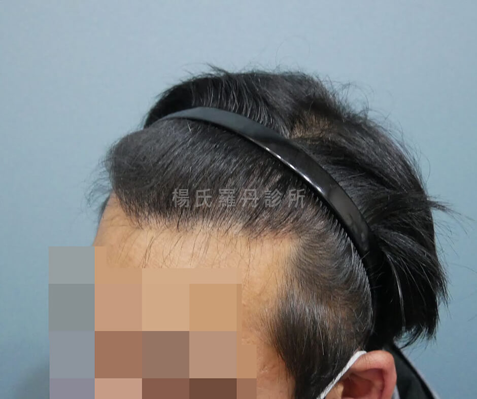 禿頭 生髮613 植髮 植髮手術