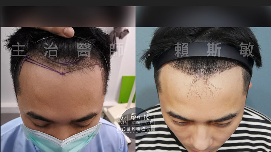 美型植髮 髮際線 六合一三階段雄性禿治療 植髮 