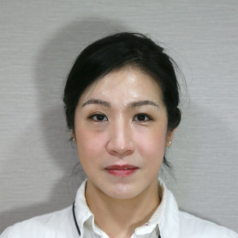 除眼袋 眼袋消除 眼袋