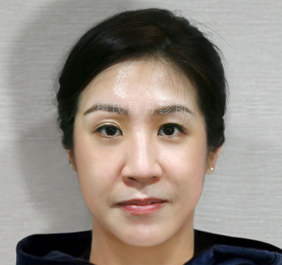 眼袋 眼袋手術 眼袋消除