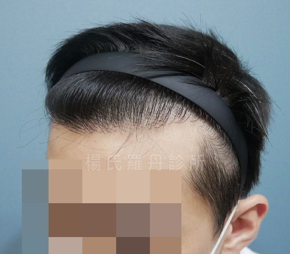 雄性禿 生髮 植髮