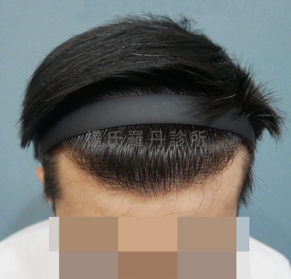 植髮 植髮手術 掉髮