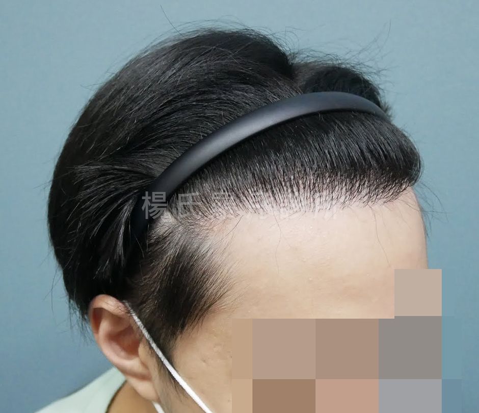 禿頭 髮際線 植髮