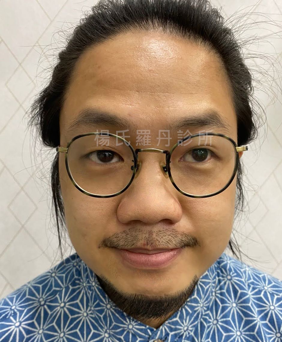 植鬍 楊氏羅丹 植髮