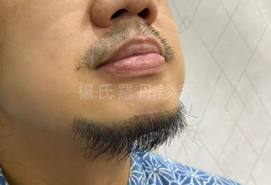 植鬍 植鬍案例 植鬍手術