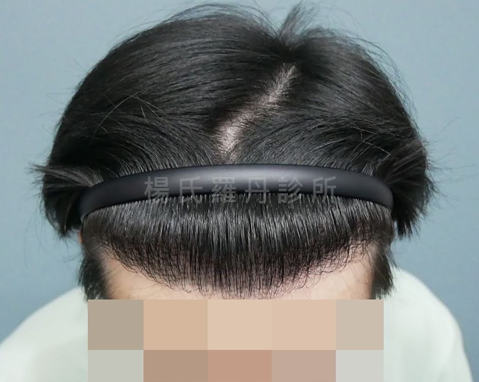 植髮 雄性禿 髮際線 禿頭