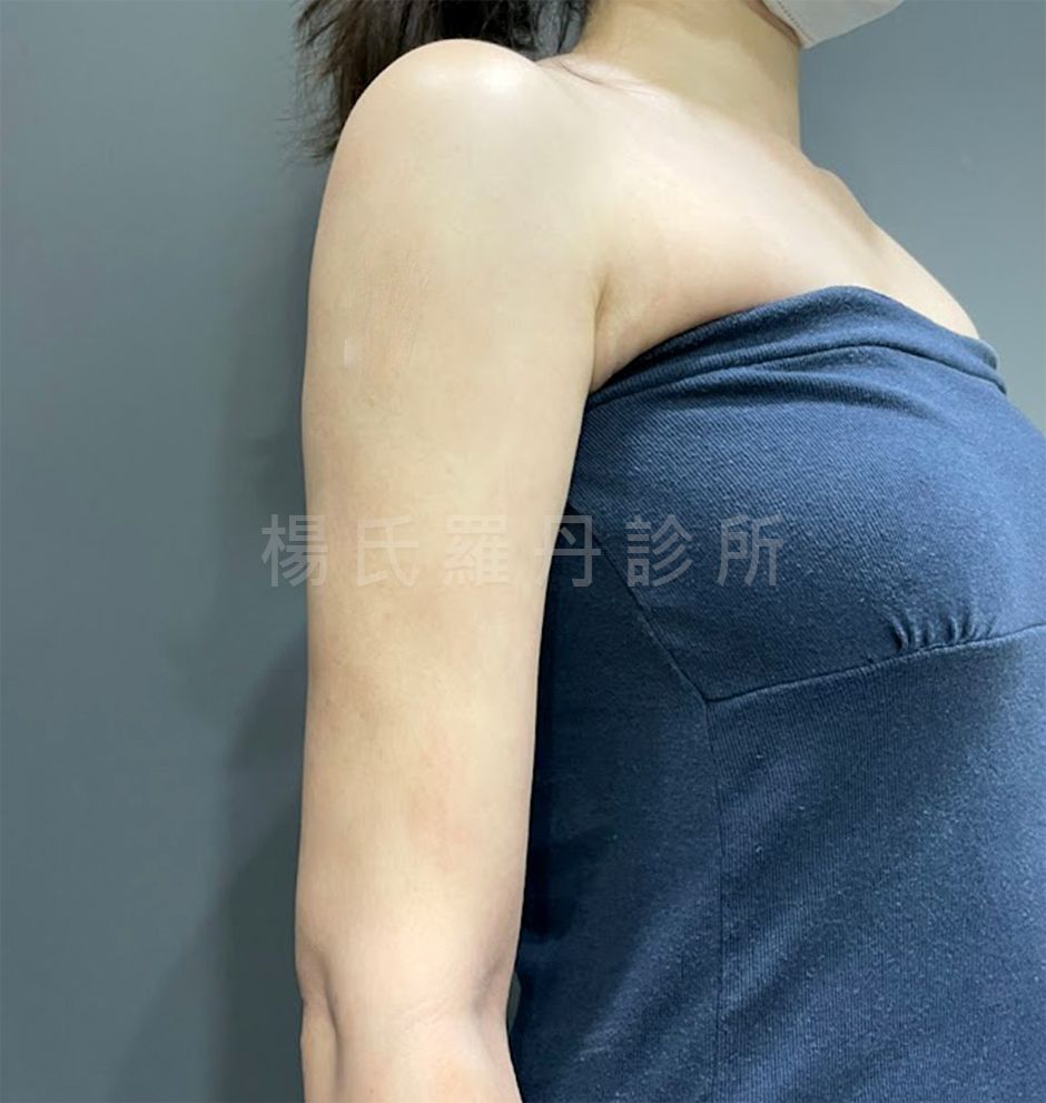 雷射減脂 瘦手臂 贅肉