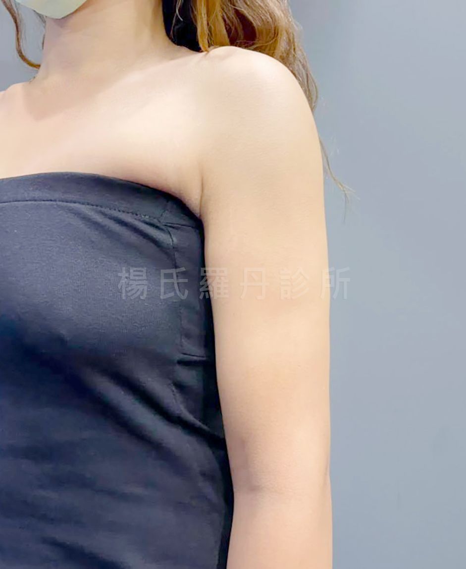 贅肉 瘦手臂 雷射減脂