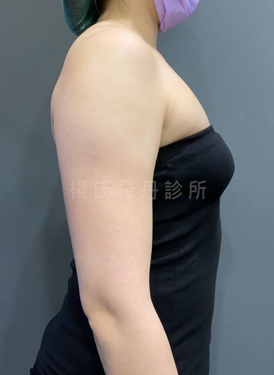 瘦手臂 雕塑 抽脂