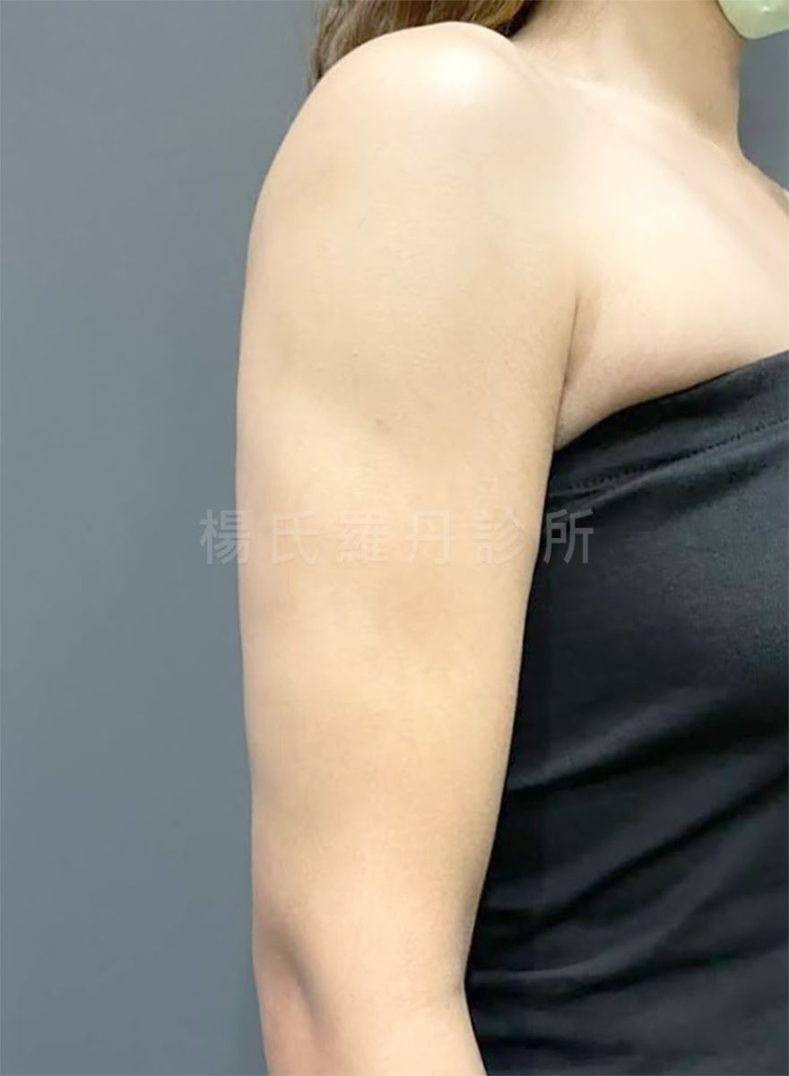 手臂抽脂 掰掰袖 抽脂