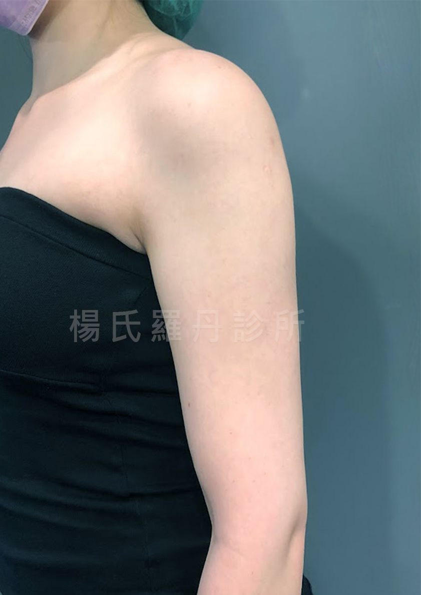 雷射減脂 蝴蝶袖 手臂