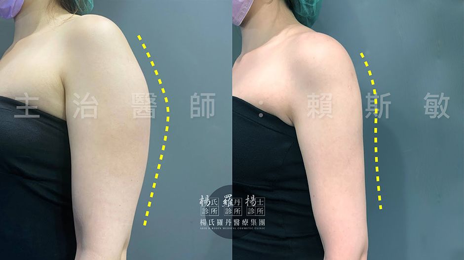 雕塑 雷射減脂 瘦手臂