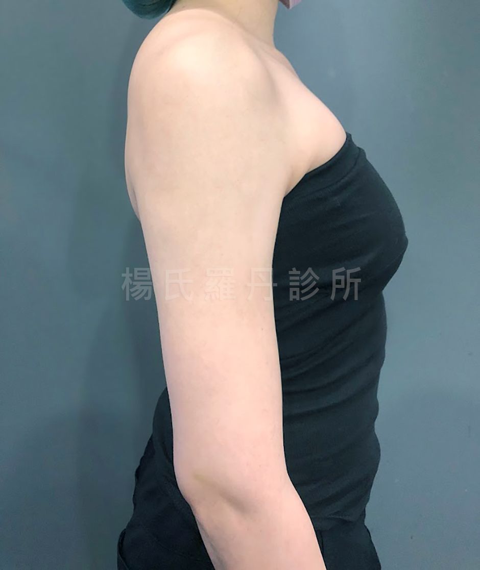 瘦手臂 雷射減脂 雕塑