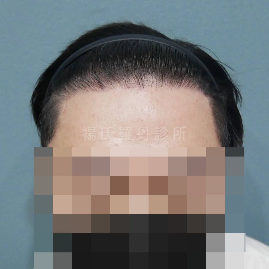 禿頭 植髮 植髮手術 六合一三階段雄性禿治療