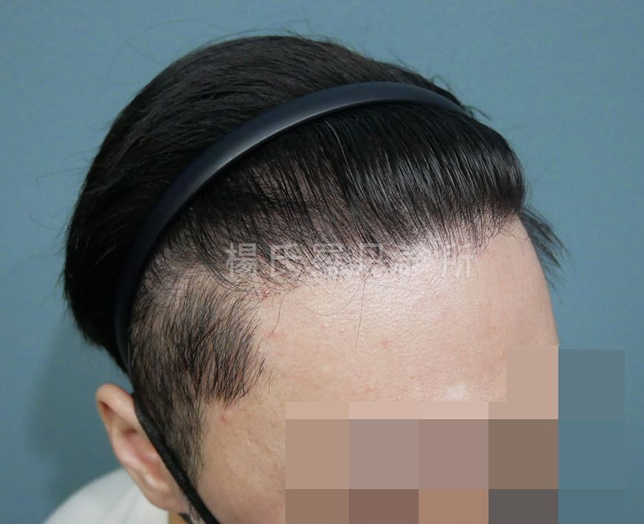 植髮手術 植髮 禿頭 生髮613