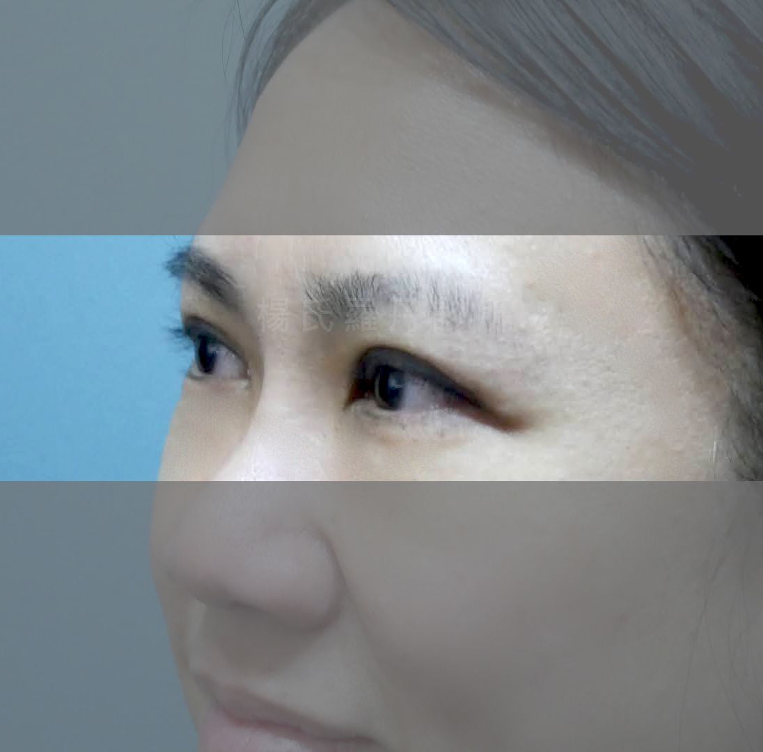 割雙眼皮 雙眼皮 雙眼皮手術