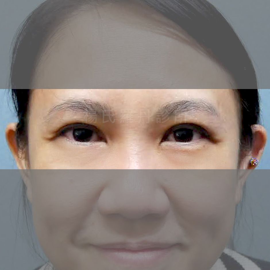 雙眼皮 割雙眼皮 雙眼皮手術