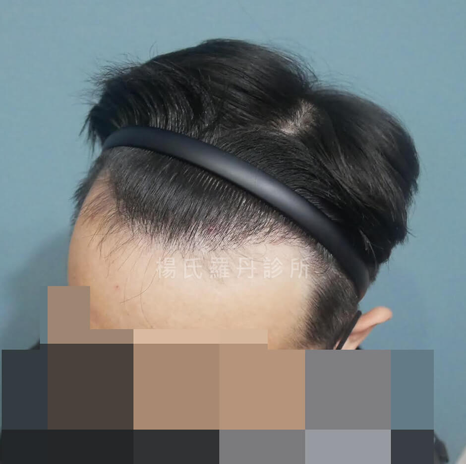 掉髮 植髮手術 植髮