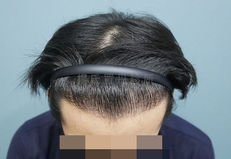 植髮 髮際線 植髮手術