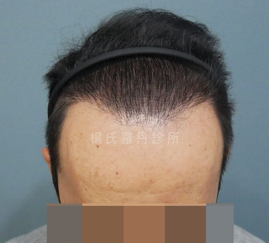 植髮 落髮 植髮手術