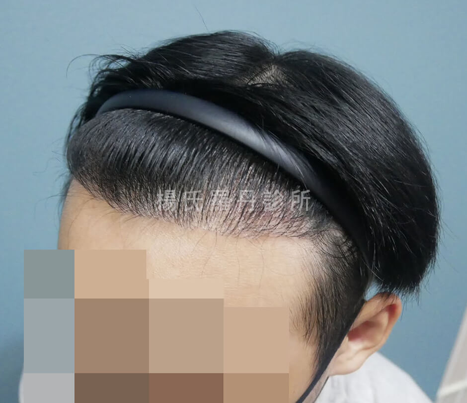 植髮手術 植髮 M型禿