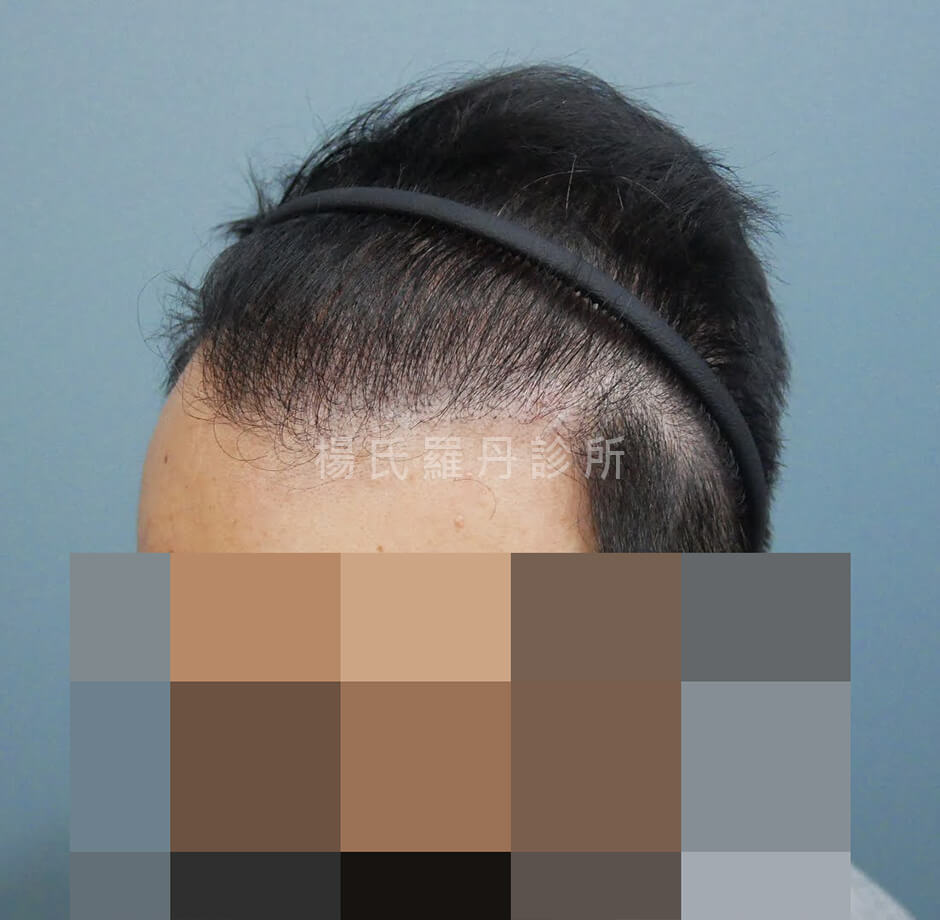 植髮 植髮手術 植髮成果