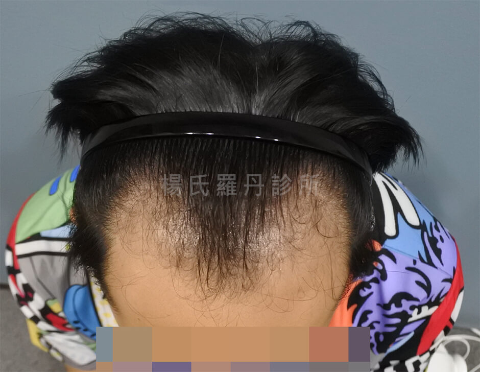 植髮 植髮手術 髮際線