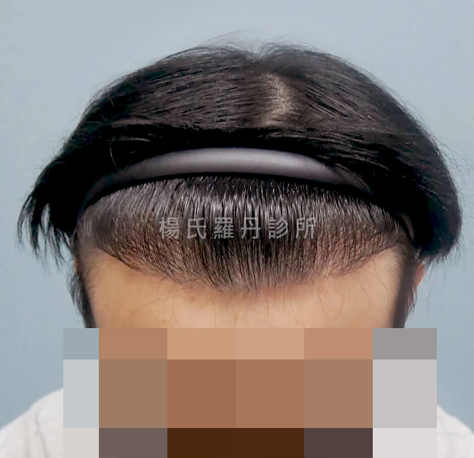 M型禿 植髮 髮際線