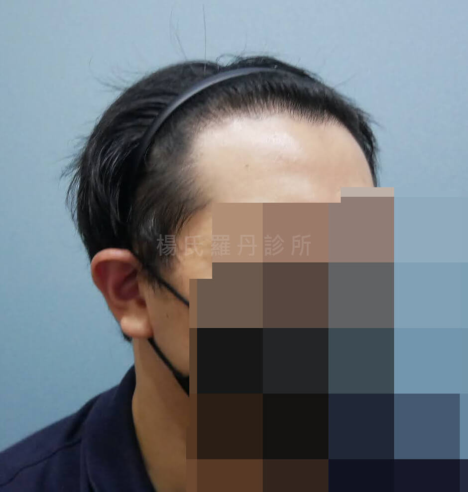 植髮手術 植髮 落髮