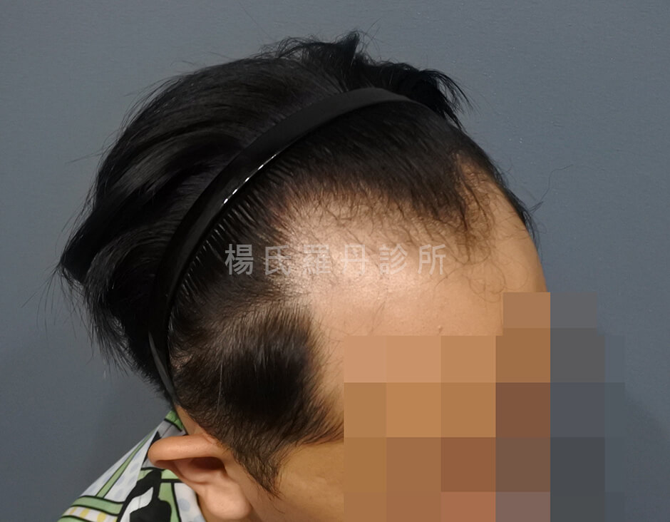 髮際線 植髮 植髮成果