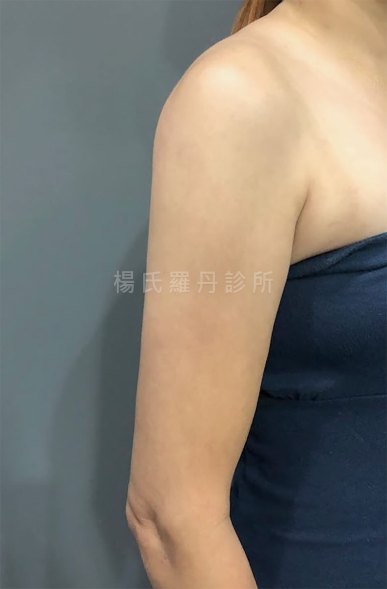 雷射減脂 抽脂 瘦手臂